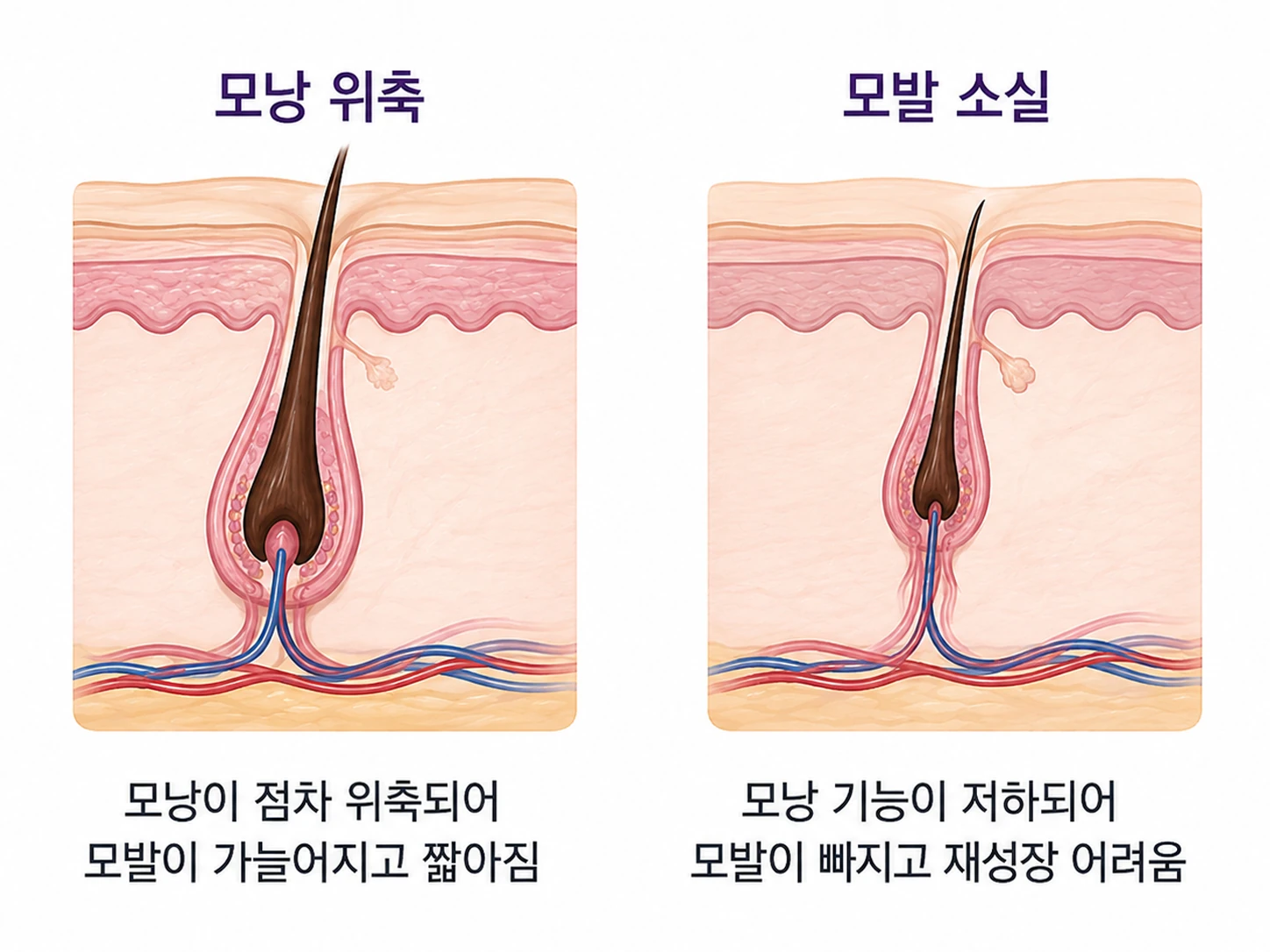자가면역 모낭질환