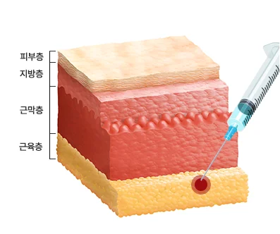 보톡스