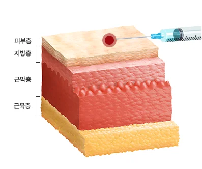 더모톡신